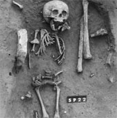 The first case of Down syndrome in human history