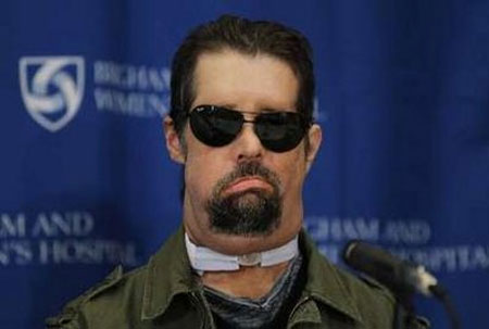 The first comprehensive face transplant in the United States to meet the press