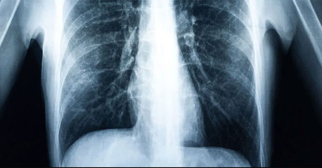 The first patient in the world to have a lung transplant due to vaping