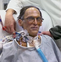 The first person to live without a heartbeat
