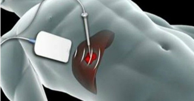 The first time a liver tumor is removed does not need to open the abdomen