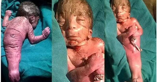The fourth 'fishman' in the world was born