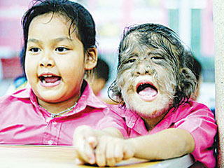 The gene mutation turns people into 'wolves'.