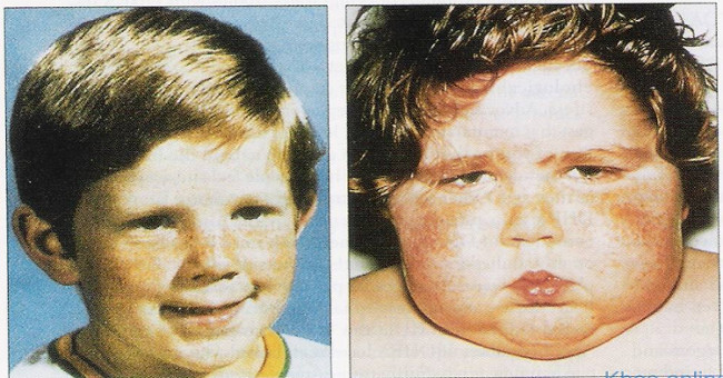 The girl has a round face like the moon due to the disease only 20 people in the world suffer