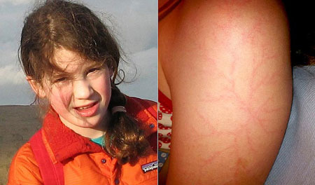 The girl survived miraculously after being struck by lightning