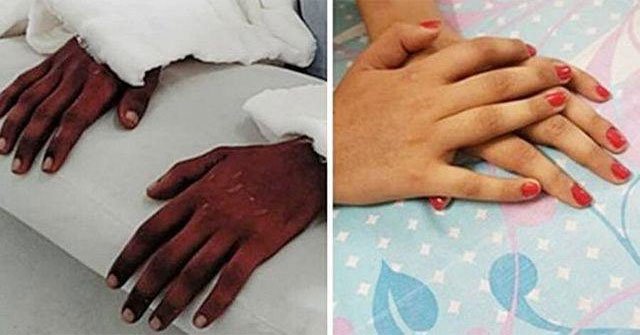 The girl was hand grafted from black young man, 2 years after the miracle happened