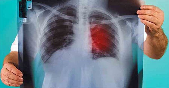 The groundbreaking method takes the lungs out of the body to 'clean' the cancer