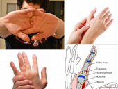 The habit of breaking knuckles harms health?