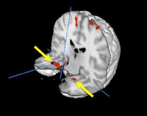 The human brain changes after experiencing a plane crash
