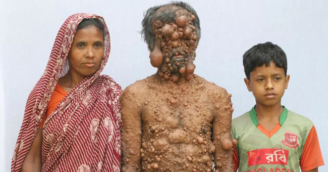 The hundred u man is shunned in Bangladesh