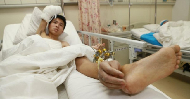 The implant has a hand that is nourished on the leg
