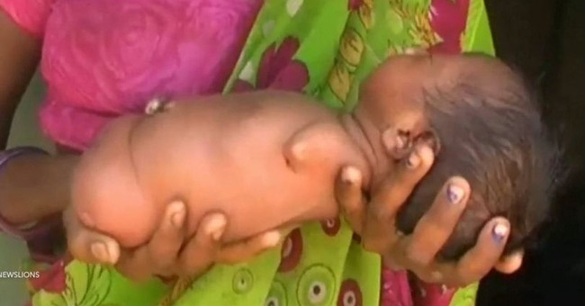 The Indian Baby Skull Girl born in India is like a meatball without limbs