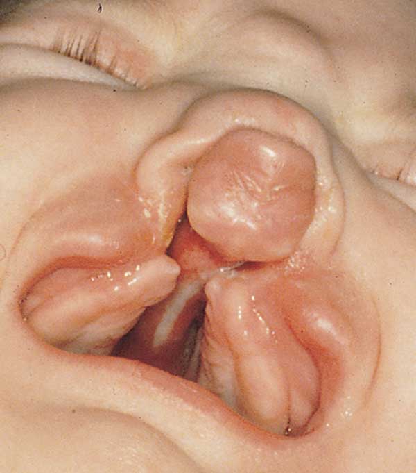 The key to evolution of birth disorders
