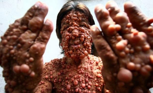 The man grows thousands of bubbles on the skin