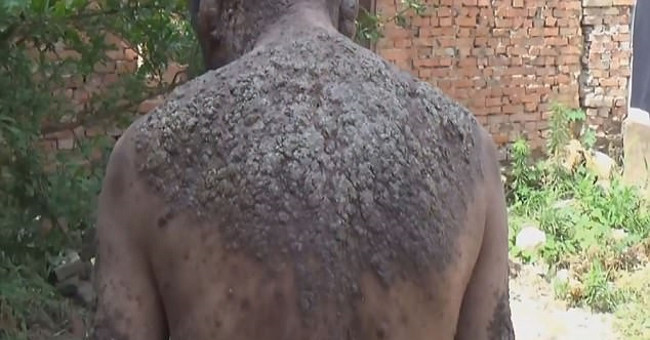 The man was driven away by the whole village because of the skin like a tree trunk