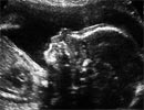 The mother is twins from two wombs