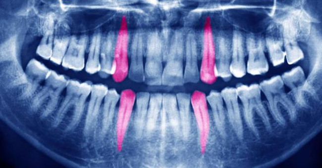 The mysterious cases of tooth exploding in history