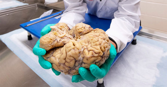 The mysterious disease is only diagnosed after the patient has died, because the doctor needs to cut their brain