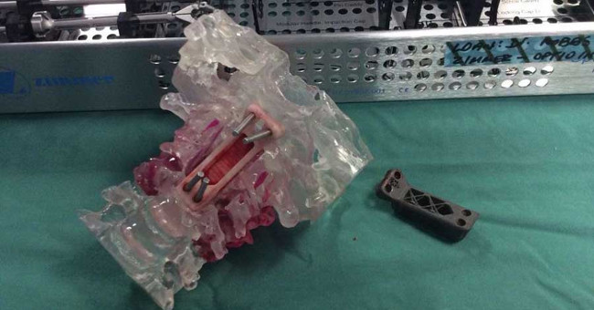 The neck vertebra transplant surgery with the first 3D printing technology was successful