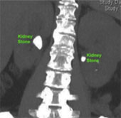 The new method allows two kidneys to be removed at the same time