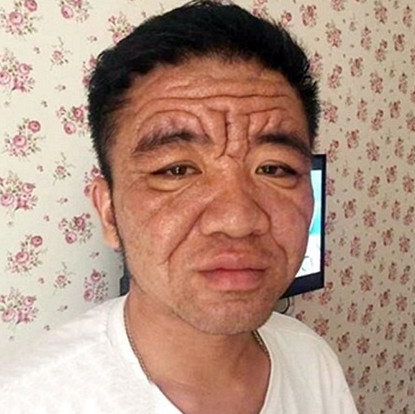 The old man wrinkled like an old man because of strange disease