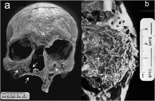 The oldest evidence of leprosy in India