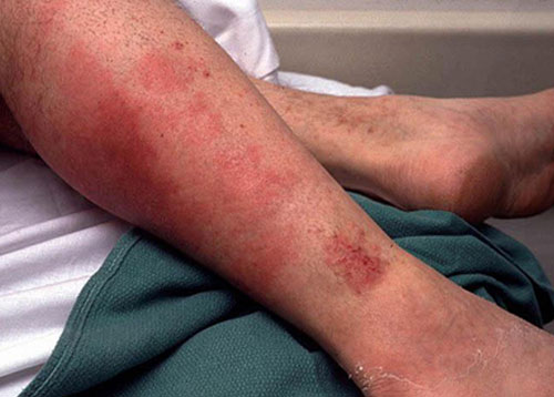 The outbreak of scarlet fever outbreaks in Hong Kong
