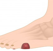 The patch heals the wound in diabetic feet