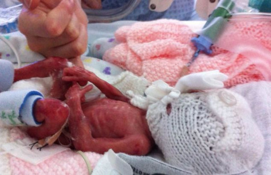 The premature baby lives on the wrong doctor