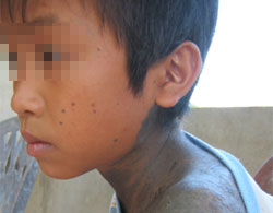The Quang Binh boy grew hair like a werewolf
