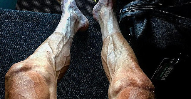 The reason why the athlete's foot is horribly deformed