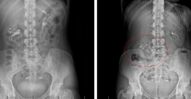 The reason why this woman's kidneys fell down to ... pelvic holes