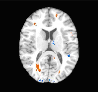 The relationship between tremors and brain tissue damage