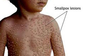 The risk of dispersing smallpox virus through biological weapons