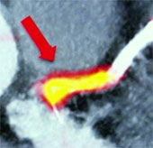The risk of heart attack can be detected by new tomography techniques