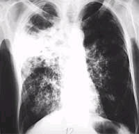 The risk of occurrence of extremely dangerous resistant TB bacteria in Vietnam