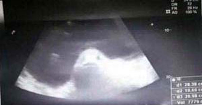 The scary truth behind the ultrasound photo of