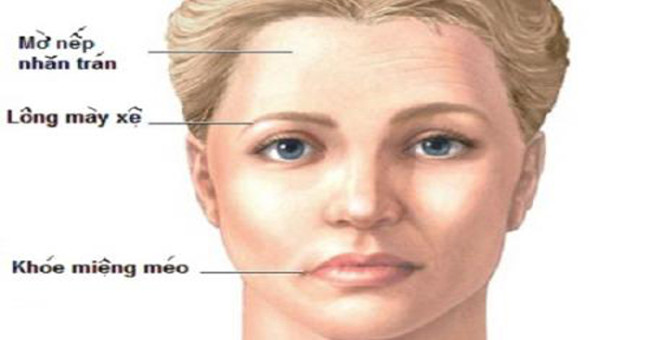 The sight of hemiplegia is more likely to occur in the winter spring