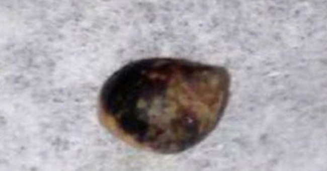 The snail grows in the body through the wound