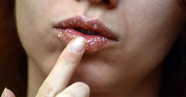The special type of honey can cure the same ulcers as antibiotics