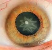 The star appears in the eye after being punched