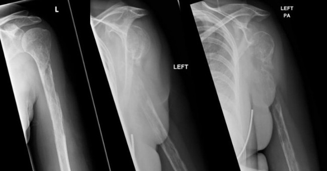 what-is-glass-bone-disease