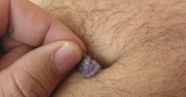 The surprising truth about the dregs 'super dirty' in the navel is not everyone has