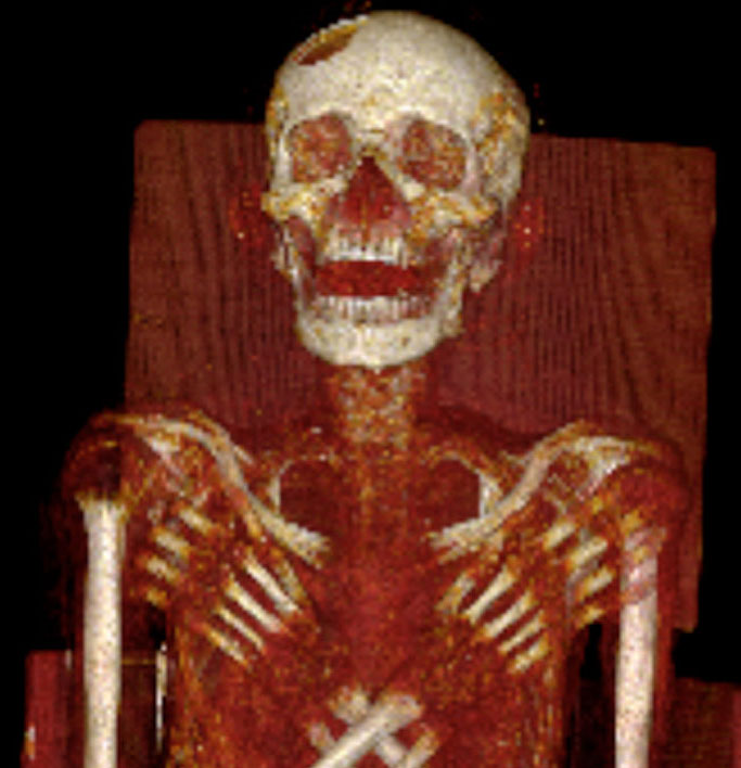 The terrible disease on ancient Egyptian mummies