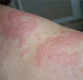 The truth is less known about allergies