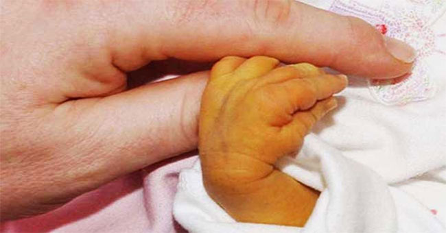 The truth needs to know about jaundice