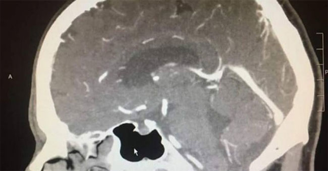 The tumor was 'wingless and flew' right before the surgery