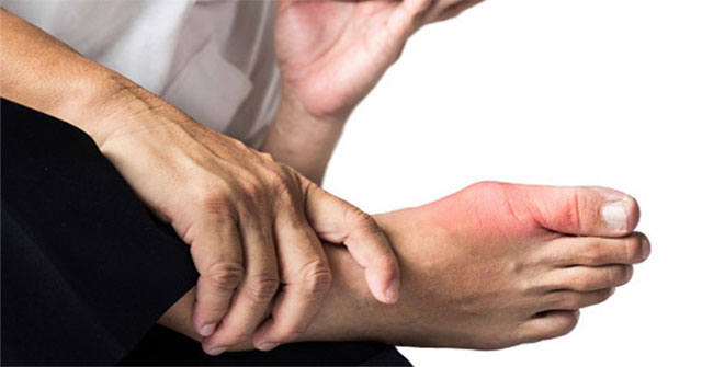 The unexpected cause makes many people susceptible to gout