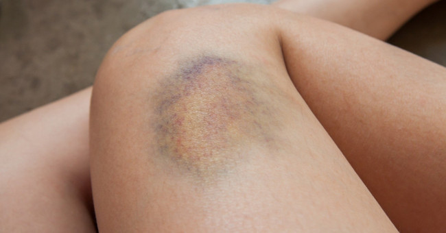The unexpected cause of your skin is bruising