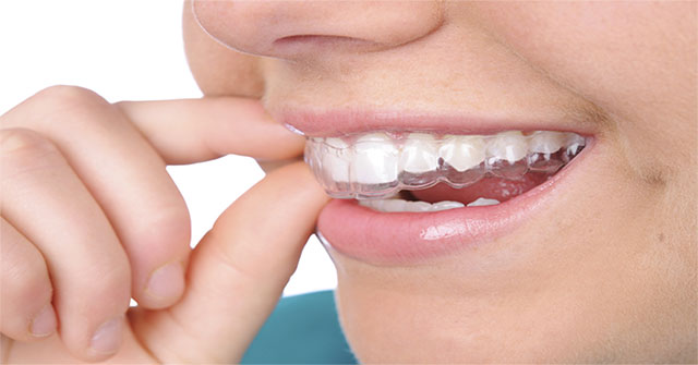 The unknown about braces throughout Invisalign